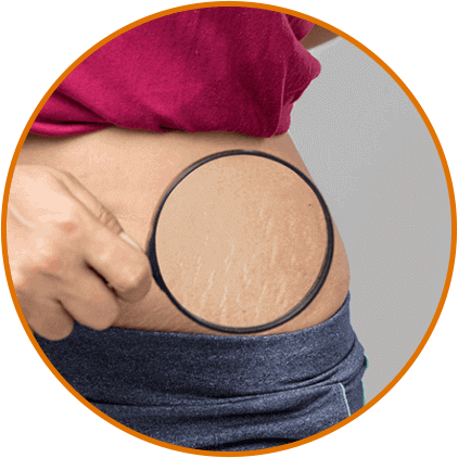 stretch marks Remove